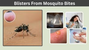 Blisters From Mosquito Bites: Causes, Signs and Treatment
