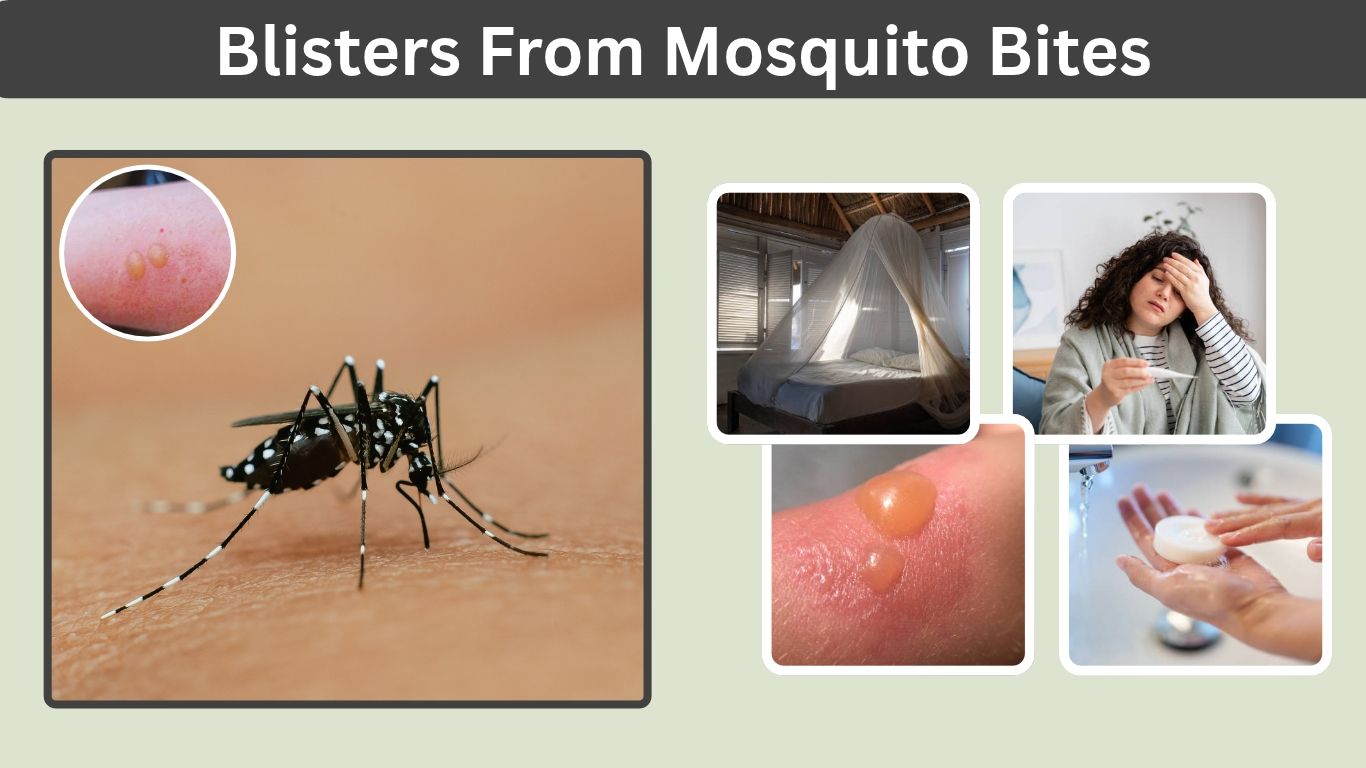 Blisters From Mosquito Bites: Causes, Signs and Treatment
