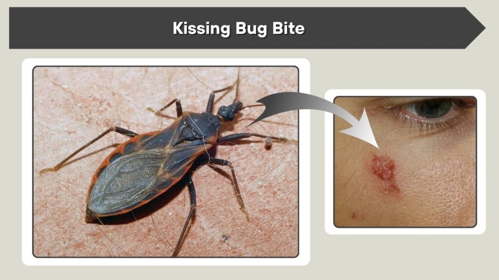 Kissing Bug Bite
