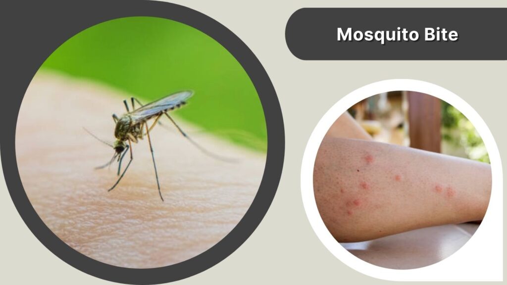 Mosquito Bite