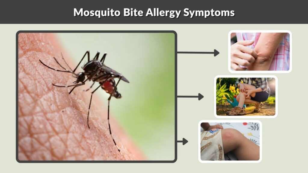 Mosquito Bite Allergy Symptoms