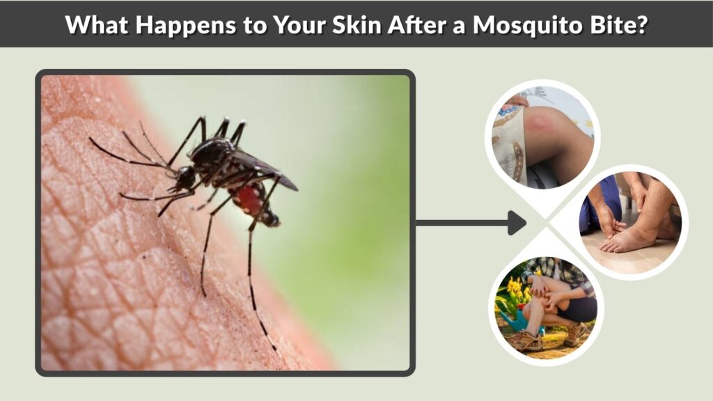 What Happens to Your Skin After a Mosquito Bite?