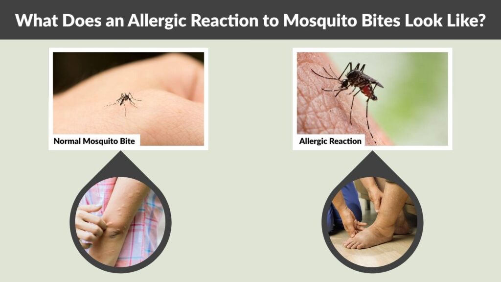 What Does an Allergic Reaction to Mosquito Bites Look Like?