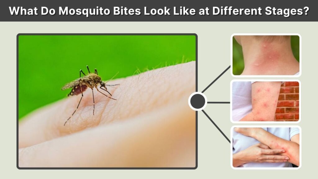 What Do Mosquito Bites Look Like at Different Stages?