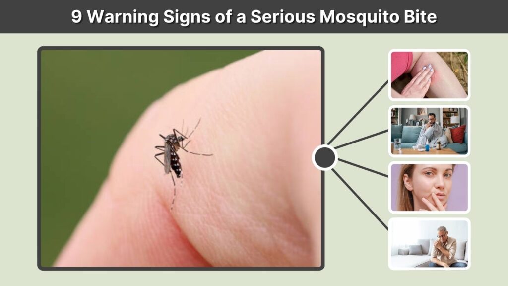 9 Warning Signs of a Serious Mosquito Bite