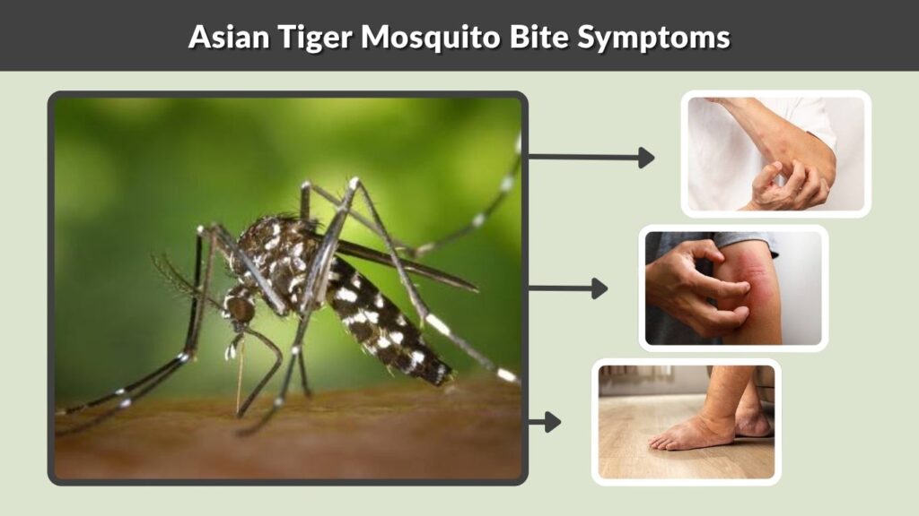 Asian Tiger Mosquito Bite Symptoms