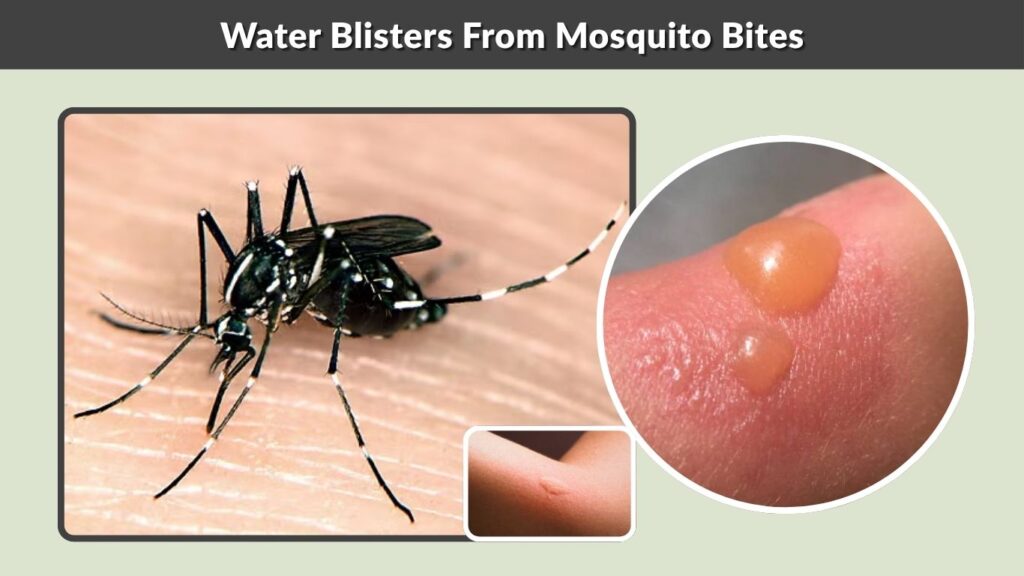 Water Blisters From Mosquito Bites