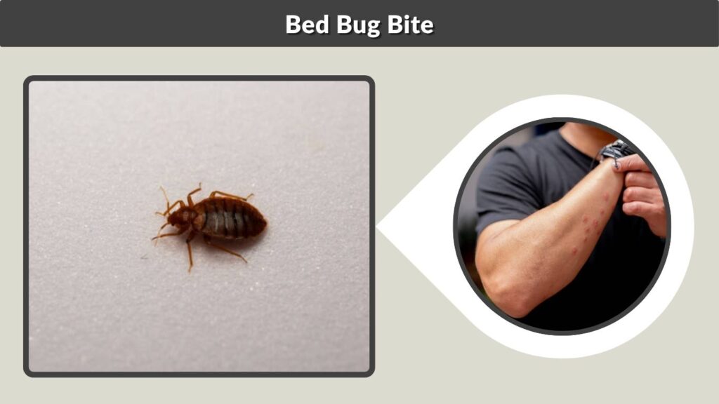 Bed Bug Bite