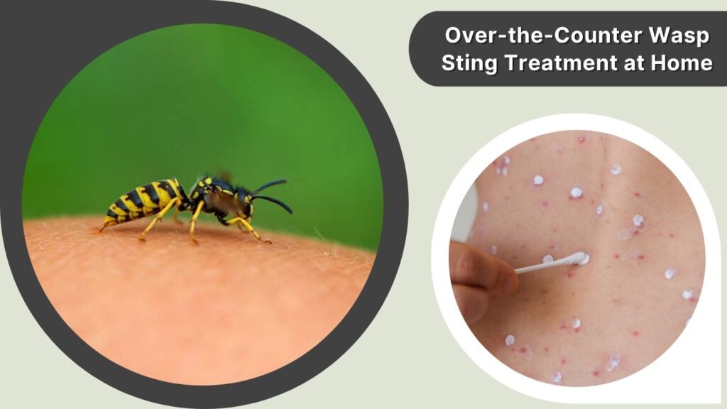 Over-the-Counter Wasp Sting Treatment at Home