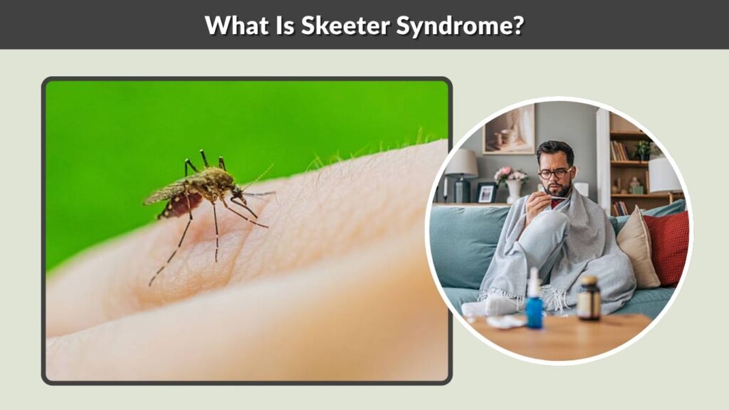 What Is Skeeter Syndrome?