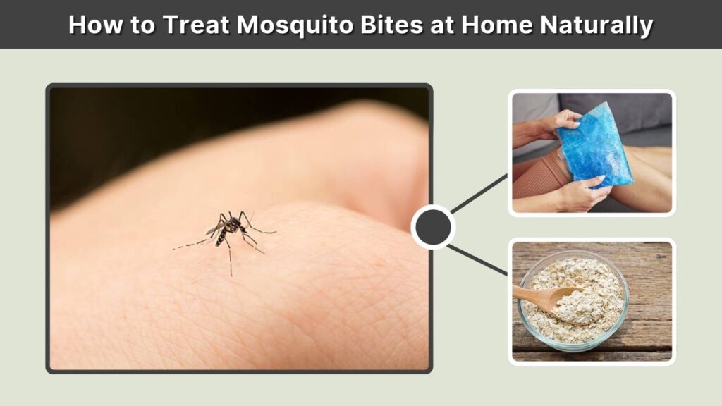 How to Treat Mosquito Bites at Home Naturally