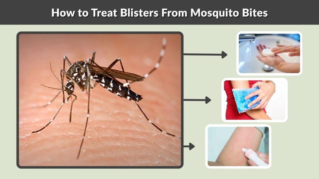 How to Treat Blisters From Mosquito Bites