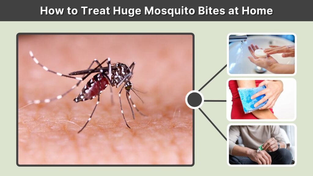 How to Treat Huge Mosquito Bites at Home