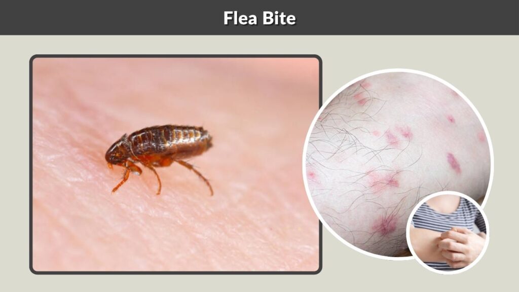  Flea Bite