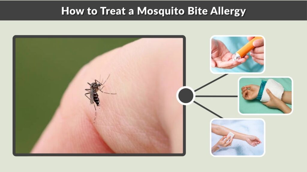 How to Treat a Mosquito Bite Allergy