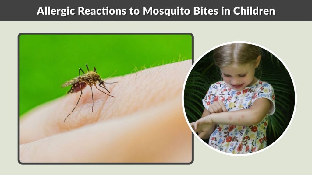 Allergic Reactions to Mosquito Bites in Children