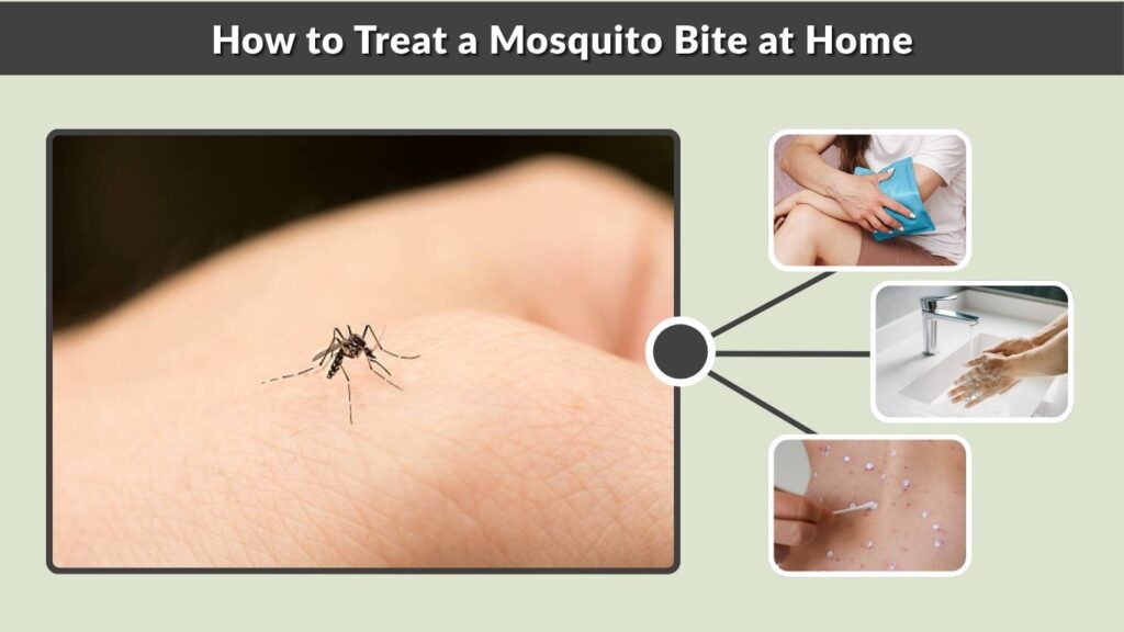 How to Treat a Mosquito Bite at Home