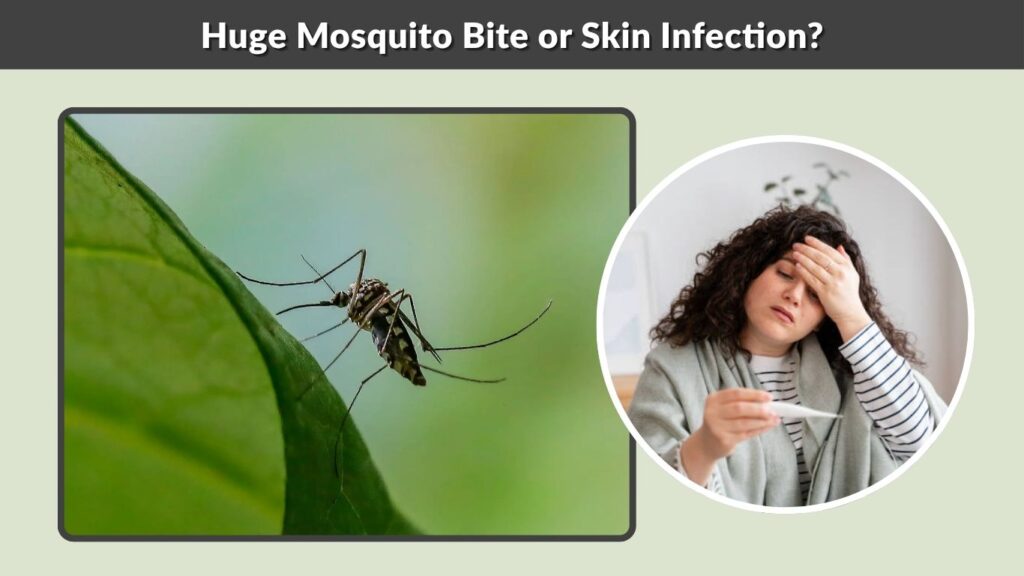 Huge Mosquito Bite or Skin Infection?