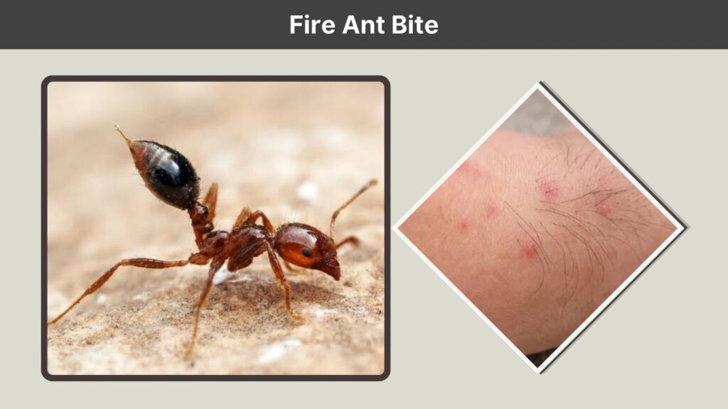 Fire Ant Bite