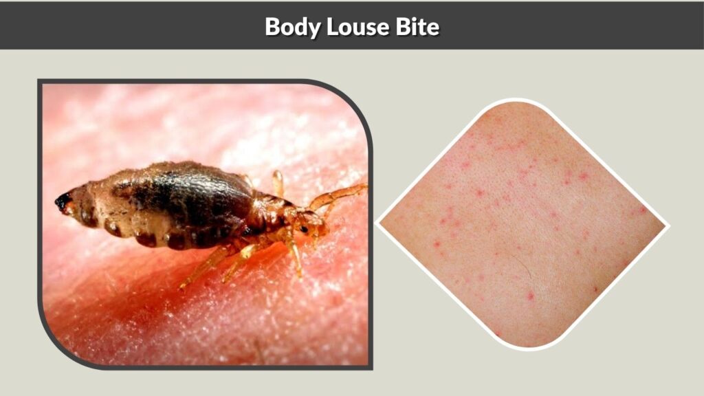 Body Louse Bite
